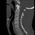 Normal trauma cervical spine (Radiopaedia 41017-43760 Sagittal bone window 19).png