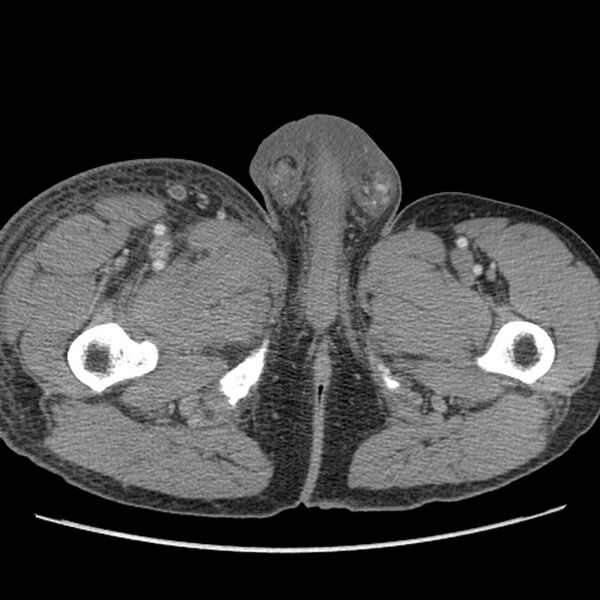 File:Obstructive bladder transitional cell carcinoma (Radiopaedia 9825-10410 A 41).jpg