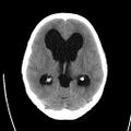 Obstructive hydrocephalus (Radiopaedia 30453-31119 Axial non-contrast 13).jpg