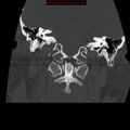Occipital condyle fracture (Radiopaedia 18366-18208 Coronal bone window 7).jpg