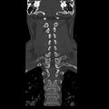 Occipital condyle fracture (Radiopaedia 31755-32691 Coronal bone window 21).jpg
