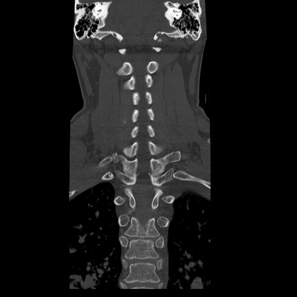 File:Occipital condyle fracture (Radiopaedia 31755-32691 Coronal bone window 21).jpg