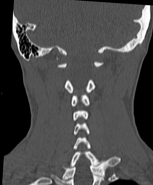 File:Occipital condyle fracture (Radiopaedia 61165-69056 Coronal bone window 4).jpg