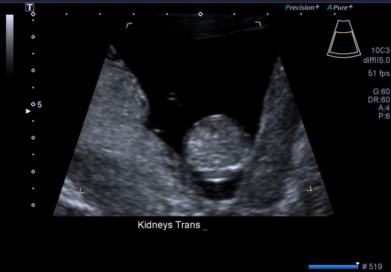 File:1st trimester nuchal-morphology ultrasound (Radiopaedia 44706-48477 General anatomy and NT 42).jpg