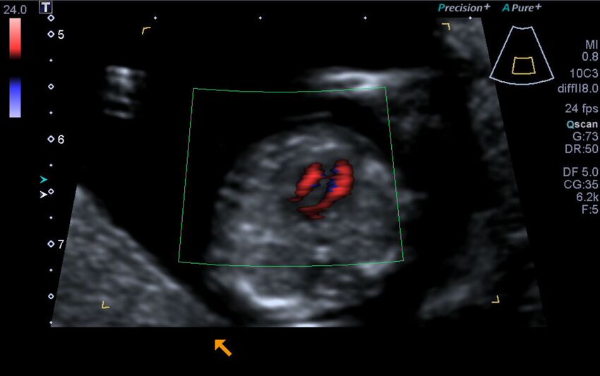 1st trimester nuchal-morphology ultrasound (Radiopaedia 44706-48477 Heart views cine with colour 104).jpg