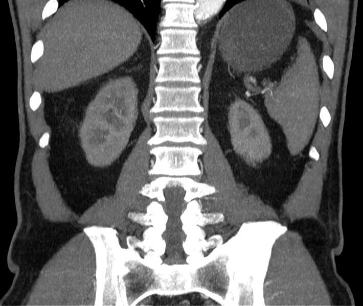 File:Abdominal aortic aneurysm (Radiopaedia 22421-22458 C 34).jpg