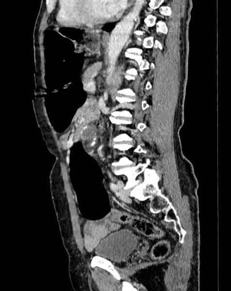 File:Abdominal aortic aneurysm (Radiopaedia 83581-98689 Sagittal C+ portal venous phase 68).jpg