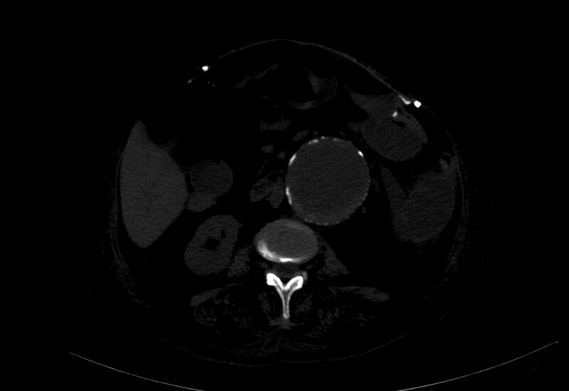 File:Abdominal aortic aneurysm - impending rupture (Radiopaedia 19233-19246 B 16).jpg