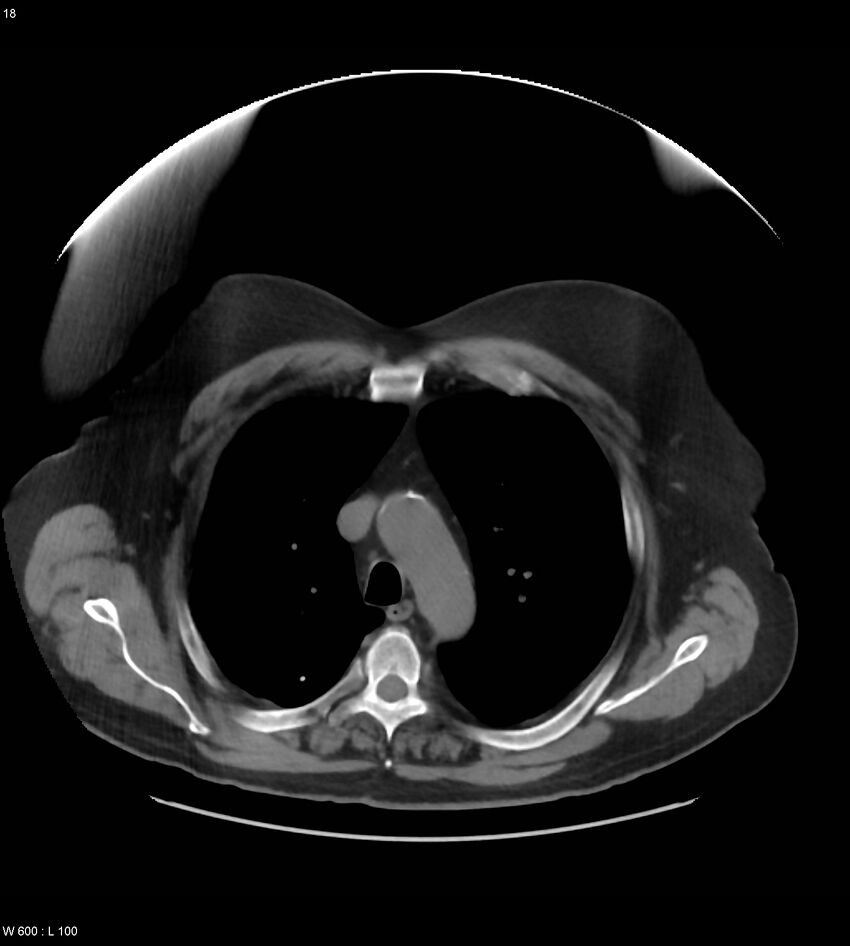 Abdominal aortic aneurysm with intramural hematoma then rupture (Radiopaedia 50278-55631 Axial non-contrast 14).jpg