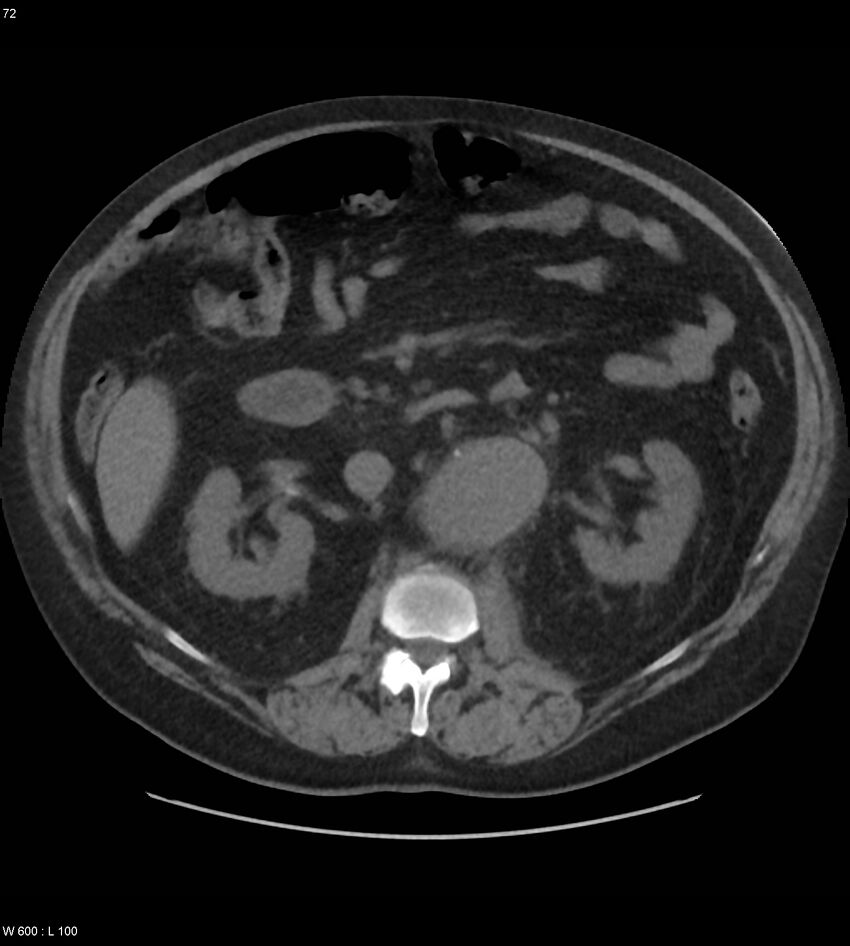 Abdominal aortic aneurysm with intramural hematoma then rupture (Radiopaedia 50278-55631 Axial non-contrast 68).jpg