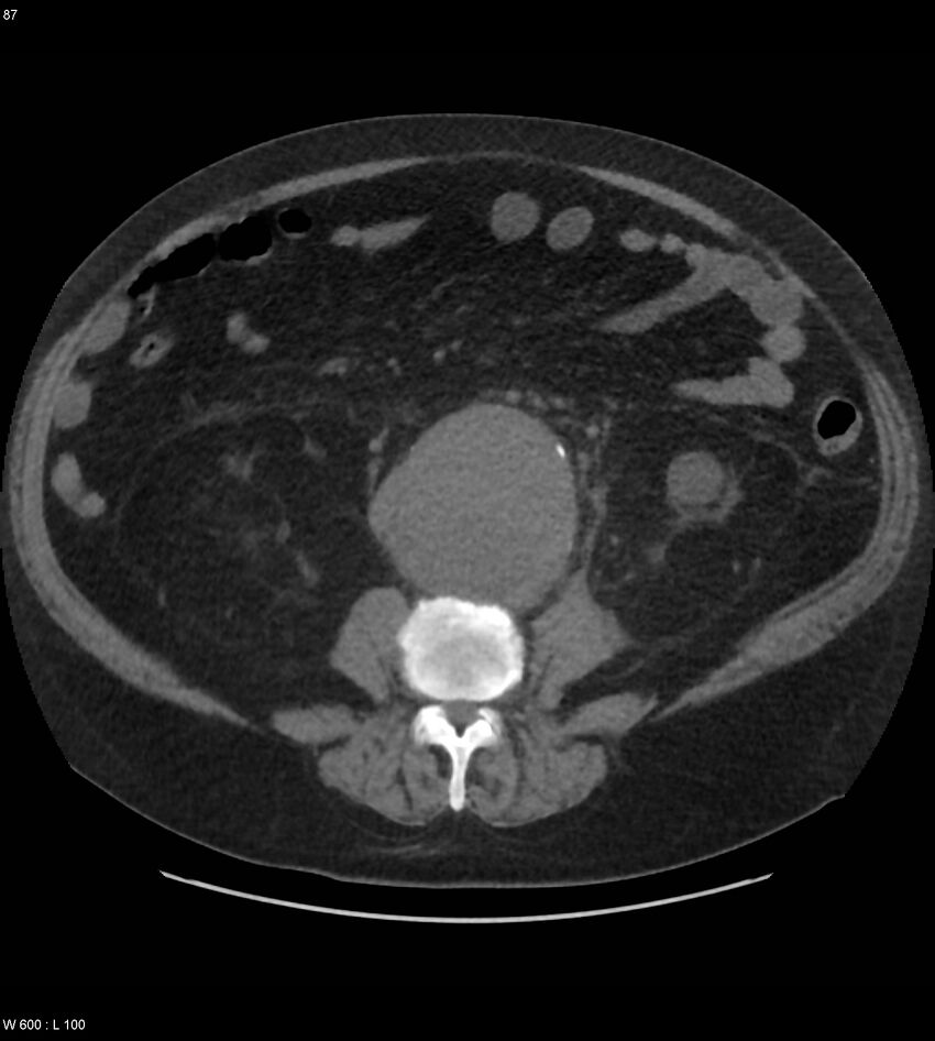 Abdominal aortic aneurysm with intramural hematoma then rupture (Radiopaedia 50278-55631 Axial non-contrast 83).jpg