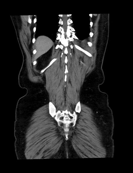 File:Abdominal lymphoma - with sandwich sign (Radiopaedia 53486-59492 C+ portal venous phase 7).jpg