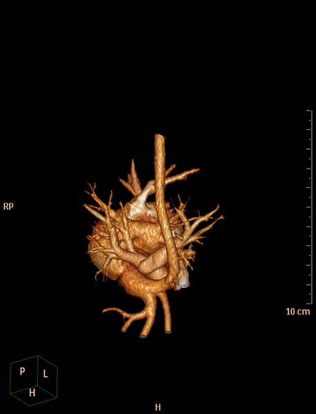 File:Aberrant left pulmonary artery (pulmonary sling) (Radiopaedia 42323-45435 3D reconstruction C+ CTPA 21).jpg