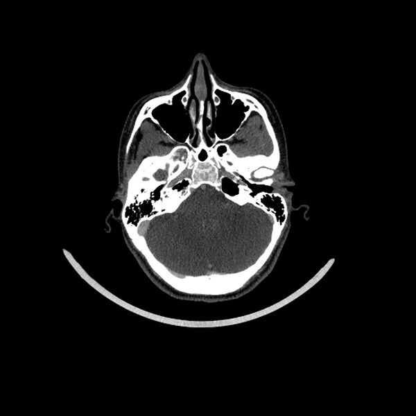 File:Aberrant right internal carotid artery (Radiopaedia 65191-74197 Axial C+ arterial phase 41).jpg