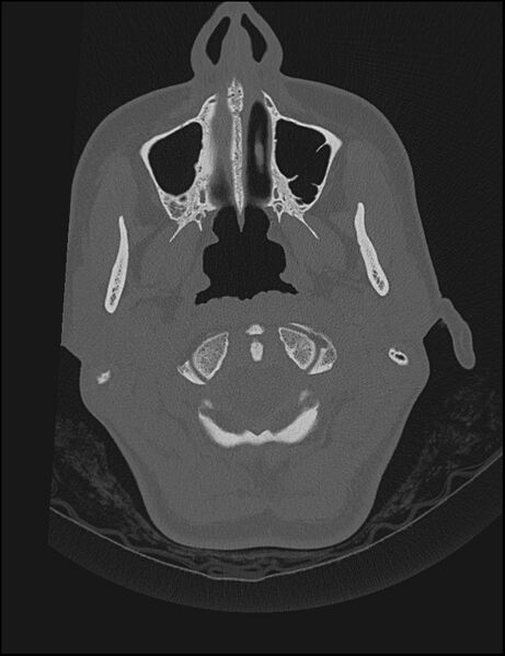 File:Aberrant right internal carotid artery (Radiopaedia 65191-74198 Axial non-contrast 4).jpg