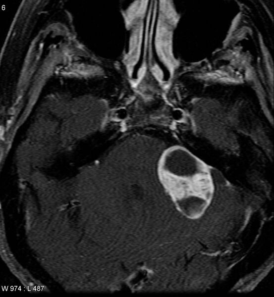 File:Acoustic schwannoma (large with cystic change) (Radiopaedia 5369-7130 Axial T1 C+ fat sat 4).jpg
