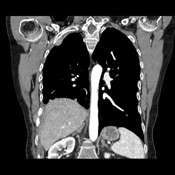 File:Acquired adrenal hyperplasia - due to thymic carcinoid tumor (Radiopaedia 21269-21184 C 6).jpg