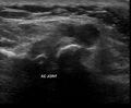 Acromioclavicular joint arthrosis with periarticular cyst (Radiopaedia 12893-13010 A 1).jpg