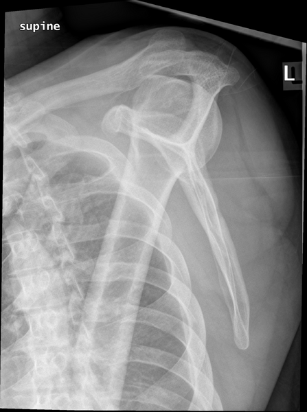 File:Acromioclavicular joint injury (type V) (Radiopaedia 44768-48582 Lateral 1).png