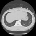Active right ventricular cardiac sarcoidosis (Radiopaedia 55596-62101 Axial lung window 43).jpg