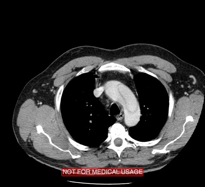 File:Acute aortic dissection - Stanford type A (Radiopaedia 40661-43285 Axial C+ portal venous phase 2).jpg