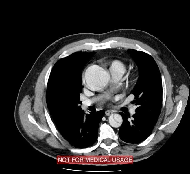 File:Acute aortic dissection - Stanford type A (Radiopaedia 40661-43285 Axial C+ portal venous phase 25).jpg