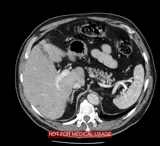 File:Acute aortic dissection - Stanford type A (Radiopaedia 40661-43285 Axial C+ portal venous phase 72).jpg