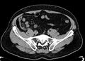 Acute appendicitis (Radiopaedia 13030-13091 Axial non-contrast 34).jpg