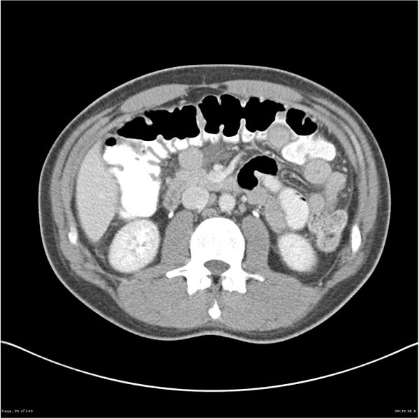 File:Acute appendicitis (Radiopaedia 25364-25615 B 26).jpg