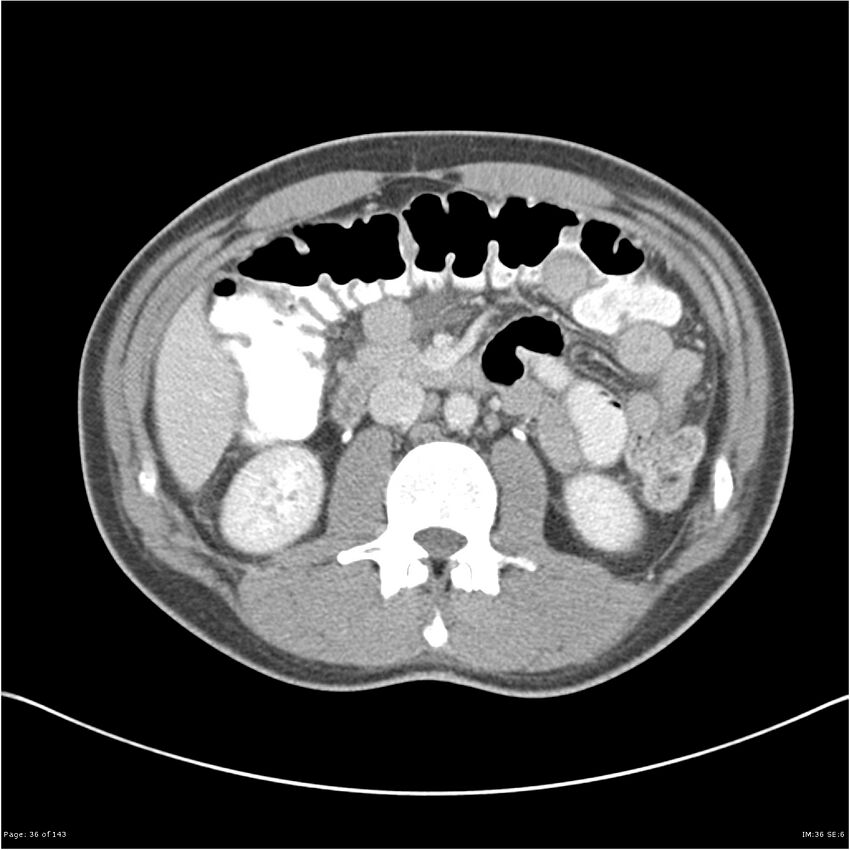 Acute appendicitis (Radiopaedia 25364-25615 B 26).jpg