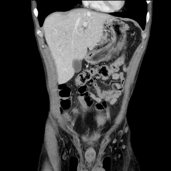 File:Acute appendicitis (Radiopaedia 27049-27227 Coronal C+ portal venous phase 15).jpg