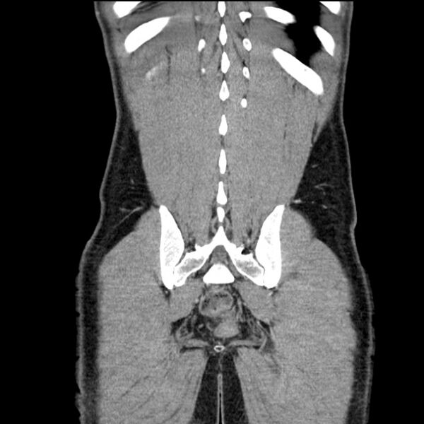 File:Acute appendicitis (Radiopaedia 27049-27227 Coronal C+ portal venous phase 50).jpg