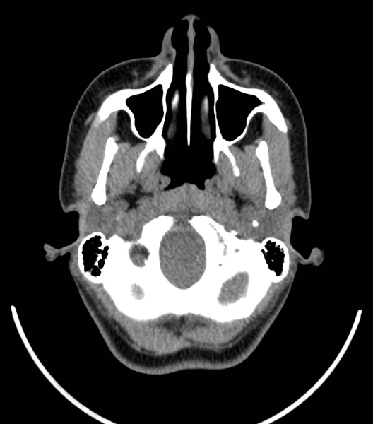 File:Acute bacterial tonsillitis (Radiopaedia 22882-22908 Axial non-contrast 6).png
