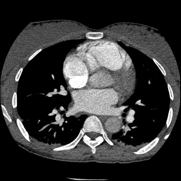 File:Acute chest syndrome - sickle cell disease (Radiopaedia 42375-45499 Axial C+ CTPA 101).jpg
