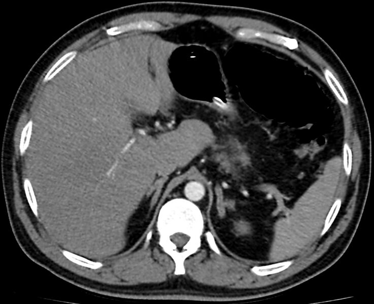 File:Acute mesenteric ischemia - superior mesenteric artery thrombosis (Radiopaedia 73947-84776 Axial C+ arterial phase 2).jpg