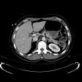 Acute myocardial infarction in CT (Radiopaedia 39947-42415 Axial C+ portal venous phase 38).jpg