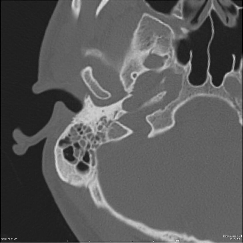 Acute otomastoiditis (Radiopaedia 28276-28512 Axial PTB bone window reformat 56).jpg