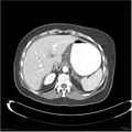 Acute pancreatitis (Radiopaedia 19136-19117 Axial C+ portal venous phase 5).jpg