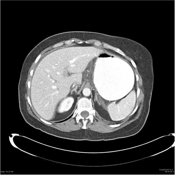 File:Acute pancreatitis (Radiopaedia 19136-19117 Axial C+ portal venous phase 5).jpg