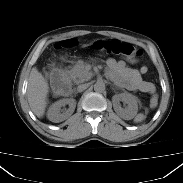 File:Acute pancreatitis (Radiopaedia 22572-22596 Axial non-contrast 23).jpg