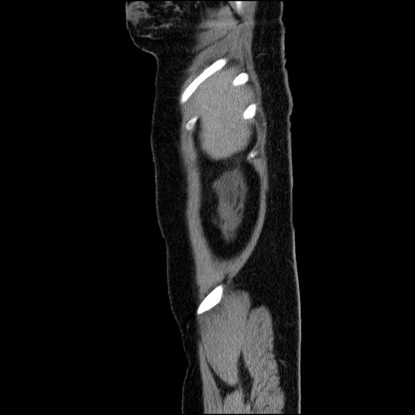 File:Acute pancreatitis (Radiopaedia 69236-79012 Sagittal C+ portal venous phase 86).jpg
