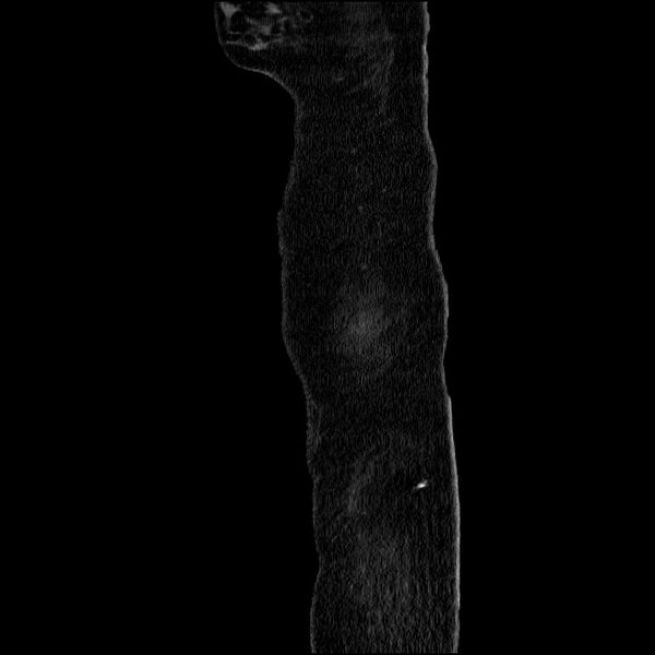 File:Acute pancreatitis (Radiopaedia 69236-79012 Sagittal C+ portal venous phase 93).jpg