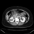 Acute pancreatitis - Balthazar C (Radiopaedia 26569-26714 Axial C+ portal venous phase 42).jpg