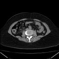 Acute pancreatitis - Balthazar C (Radiopaedia 26569-26714 Axial non-contrast 54).jpg