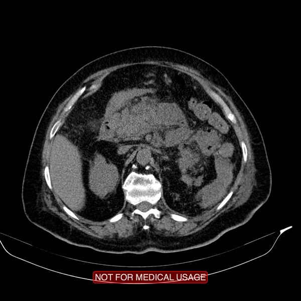 File:Acute pancreatitis with infected necrosis (Radiopaedia 26454-26585 Axial non-contrast 11).jpg