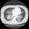 Acute pulmonary edema on CT (Radiopaedia 33582-34672 Axial lung window 31).jpg