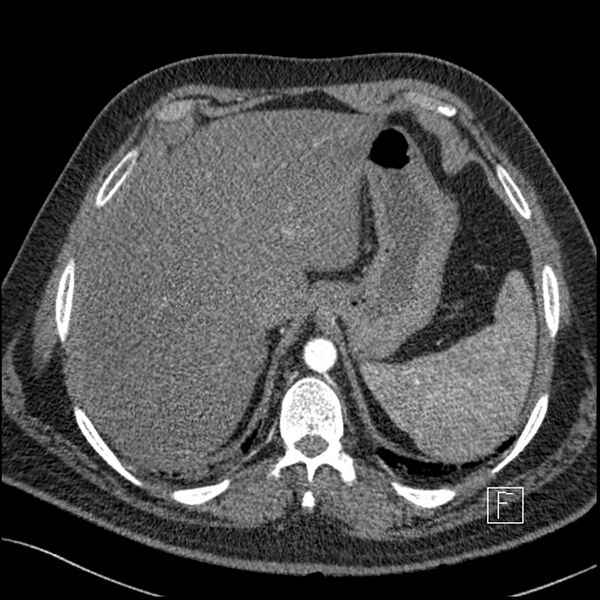 File:Acute pulmonary embolism with pulmonary infarct (Radiopaedia 73062-83768 Axial C+ CTPA 72).jpg