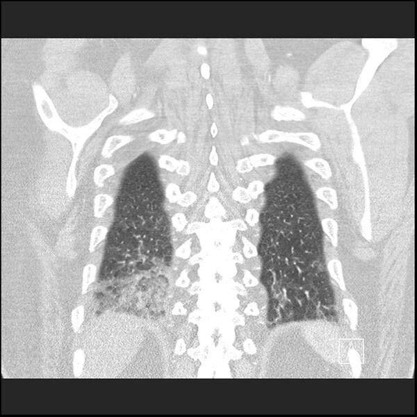 File:Acute pulmonary embolism with pulmonary infarct (Radiopaedia 73062-83768 Coronal lung window 66).jpg