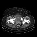 Acute pyelonephritis (Radiopaedia 25657-25837 Axial renal parenchymal phase 78).jpg