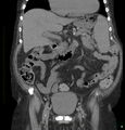 Acute renal failure post IV contrast injection- CT findings (Radiopaedia 47815-52557 Coronal non-contrast 18).jpg